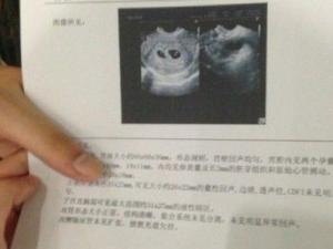 19����Ů������ǰ����ɹͼ���᲻�����˫��̥